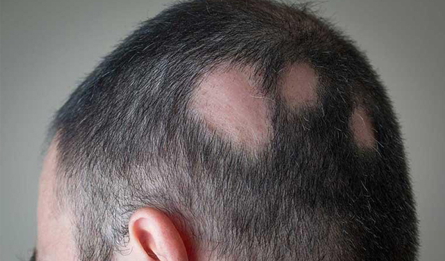 Alopecia areata Clinica dermatologica